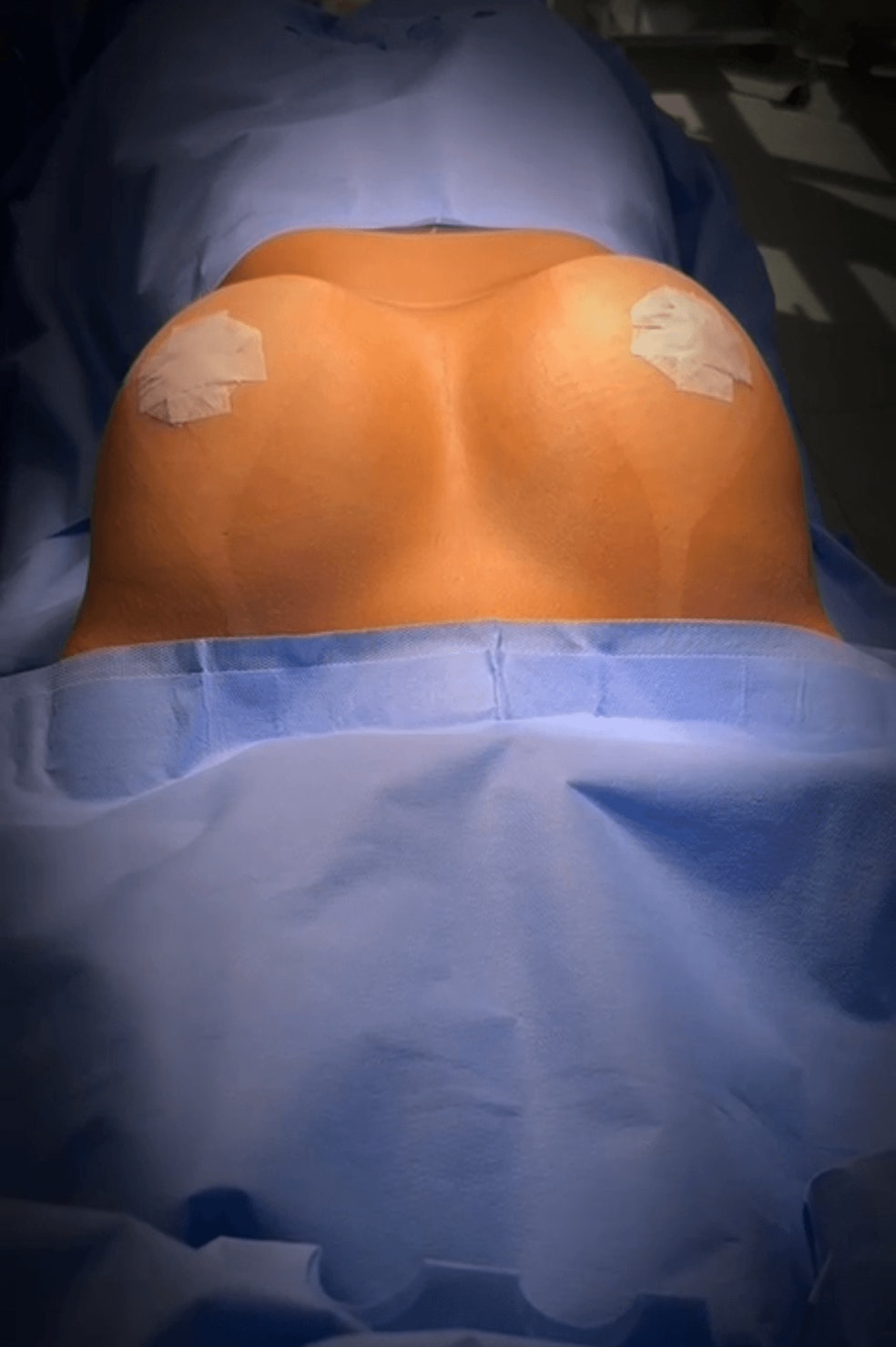 Mamoplastia de aumento mais 20 facetas em resina ou 10 k